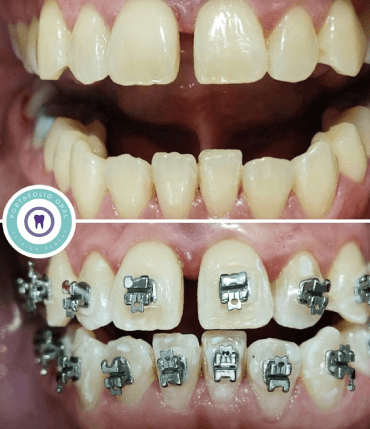 Ortodoncia con Brackets