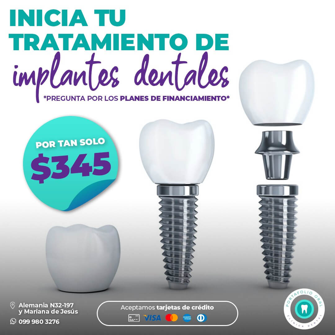 Implantes Dentales