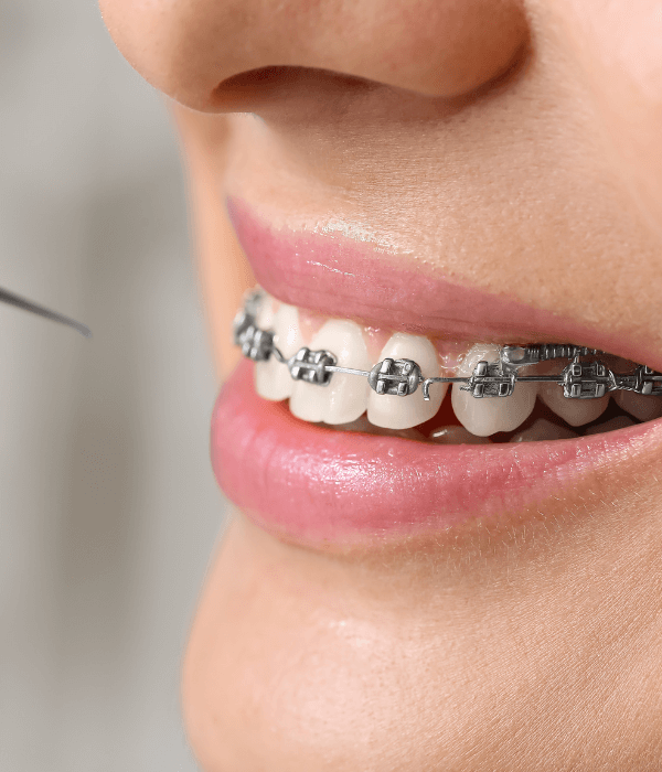 brackets-esteticos-precio-en-quito.png