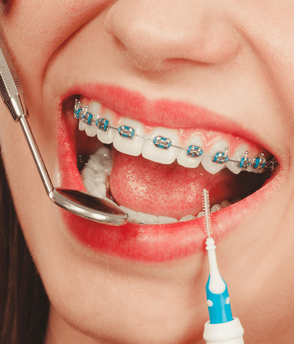 brackets-precio-cerca-de-mi.png