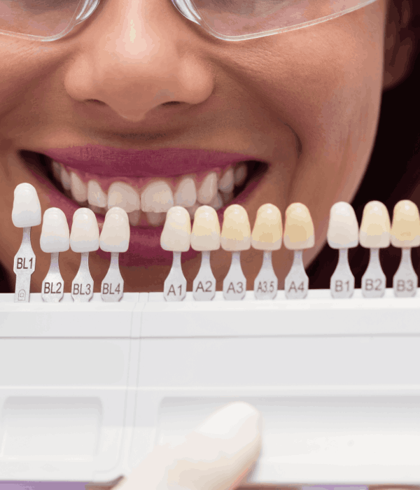 Carillas Dentales De Porcelana