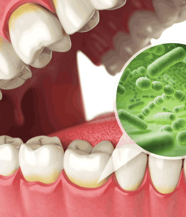 Control De Placa Bacteriana