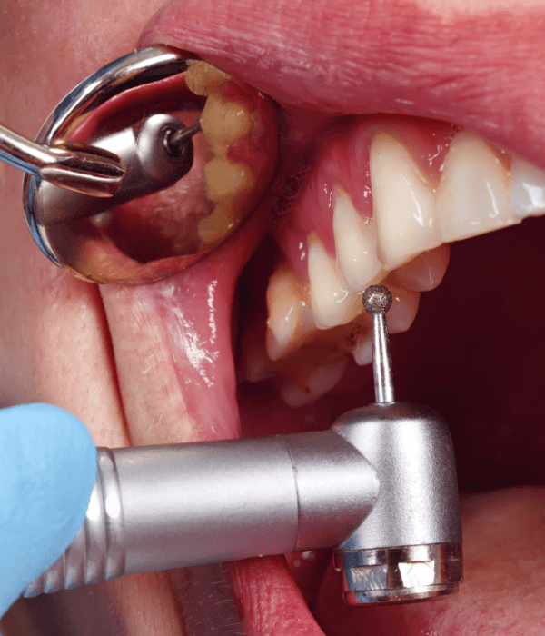 endodoncia-precio-en-quito.png