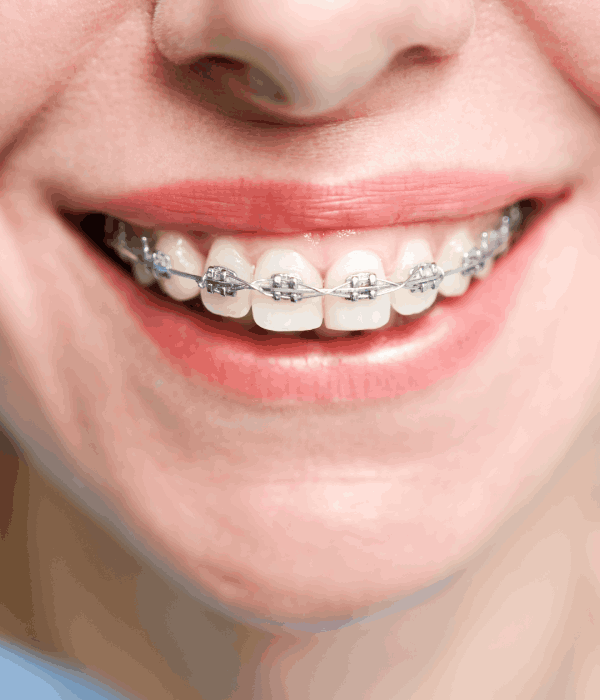 Especialista En Brackets