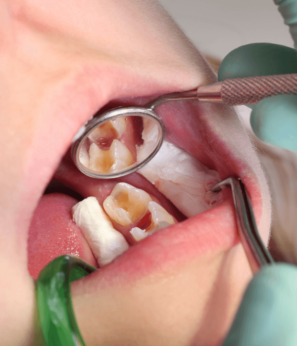 especialista-en-tratamiento-de-caries-dentales.png