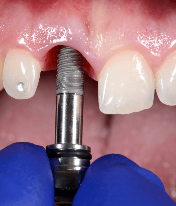 implantes-dentales-precio.png