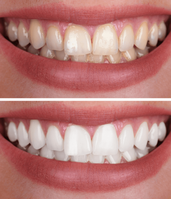 precio-de-blanqueamiento-dental.png