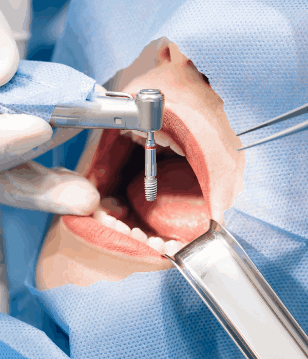 Tratamiento De Periodoncia