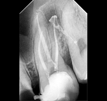 Endodoncia