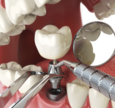 Implantes