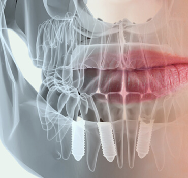 Rehabilitación Oral